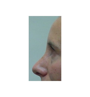 Rhinoplasty Surgery in Toronto